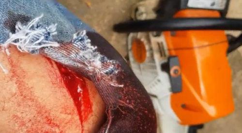 Chainsaw wound