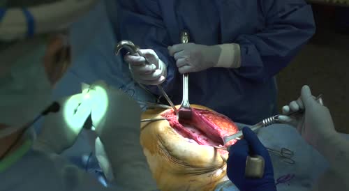 Abdominal surgury.