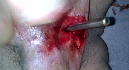 open penis